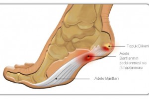 Topuk Dikeni Terliği Tavsiye