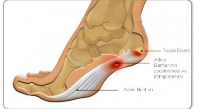 Topuk Dikeni Terliği Tavsiye Topuk Dikeni Terliği Tavsiye